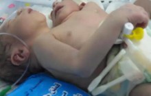 Baby born with 2 heads, 2 hearts, 3 arms