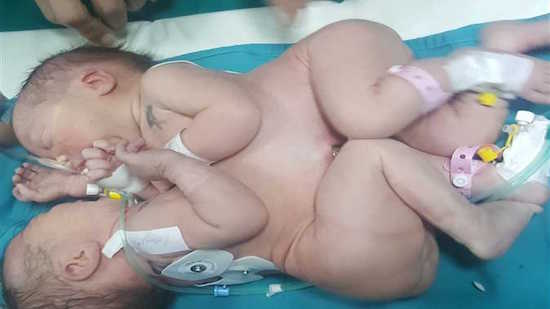 Alexandria hospital successfully separates conjoined twins