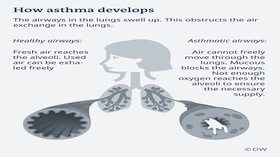 Asthma: When breathing becomes difficult